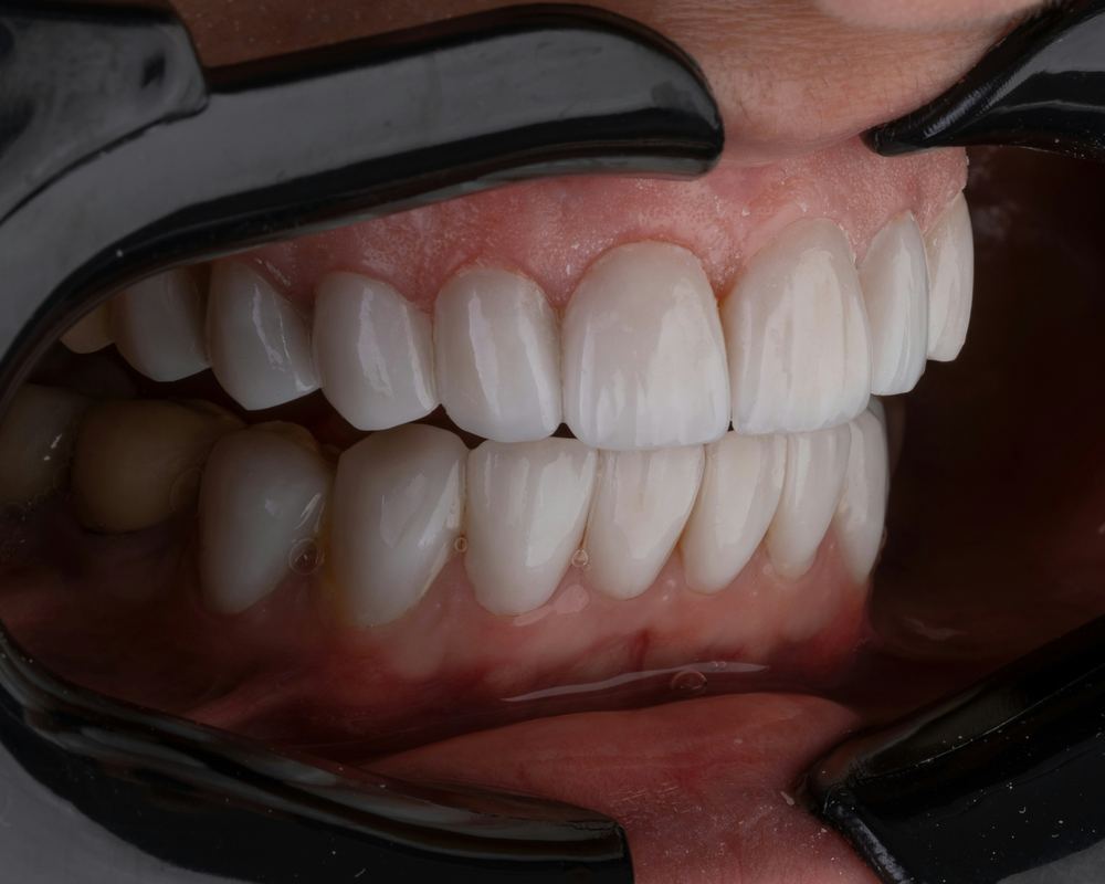 Close-up of whitened teeth
